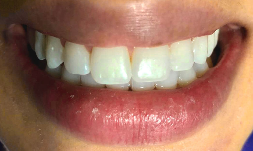 Dientes alineados antes de blanquear