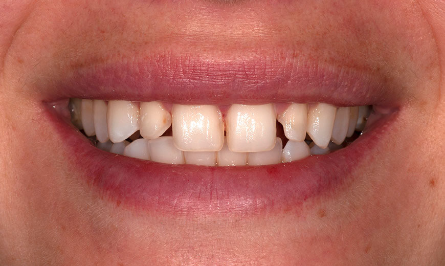 Dientes antes de colocar carillas