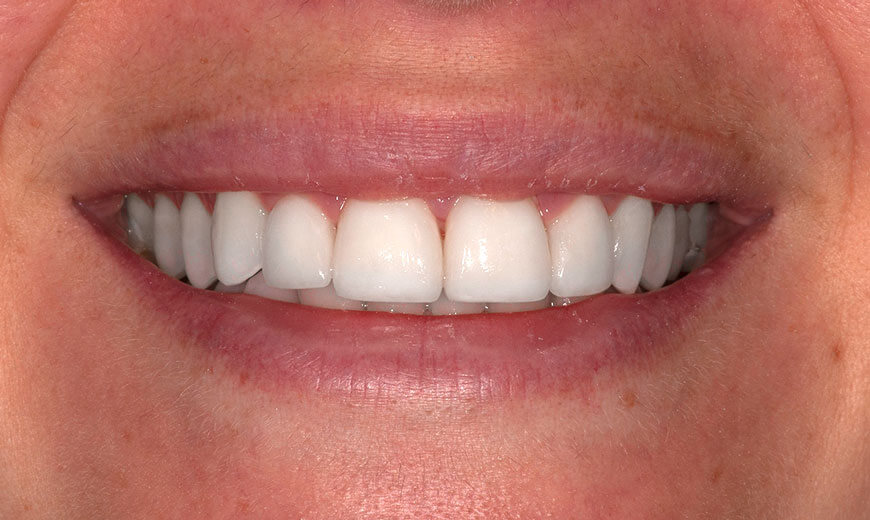 Dientes después de colocar carillas