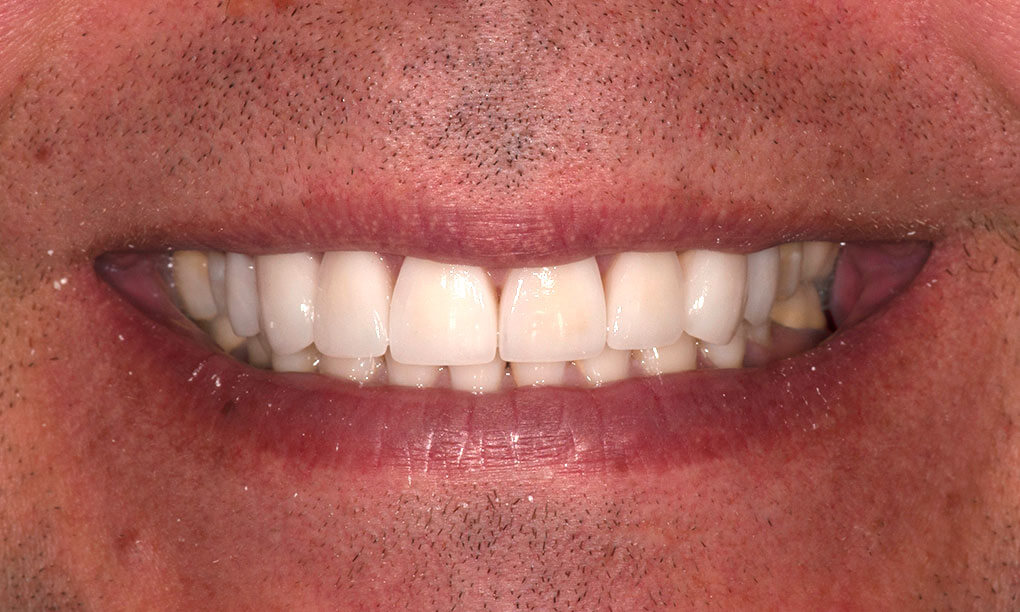 Después del diseño de sonrisa