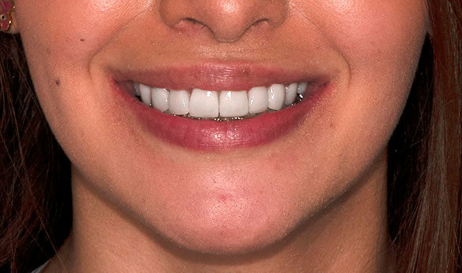 Dientes desalineados después de ortodoncia